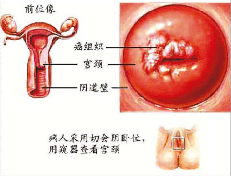 吸煙可以引起宮頸癌嗎?